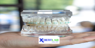 Custom-made clear aligners