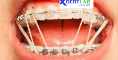 Introduce Custom orthodontic appliance manufacturer worldwide