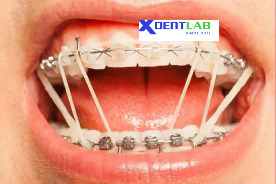 Introduce Custom orthodontic appliance manufacturer worldwide